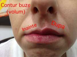 Micropigmentare buze - Elisabeta Vladescu